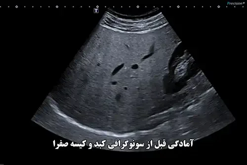 آمادگی قبل از سونوگرافی کبد و کیسه صفرا