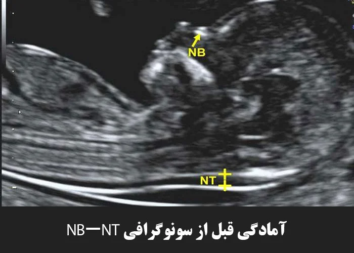 آمادگی قبل از سونوگرافی NB-NT