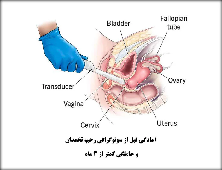 آمادگی قبل از سونوگرافی رحم، تخمدان و حاملگی کمتر از 3 ماه