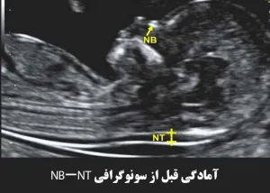 آمادگی قبل از سونوگرافی NB-NT